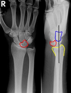 Image result for Lunate Dislocation Reduction