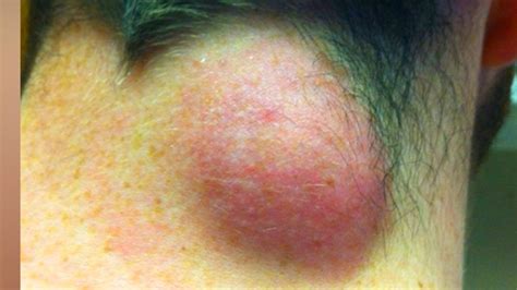 Exploding Zits and Boils 的图像结果