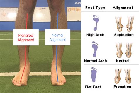 Overpronation Exercises