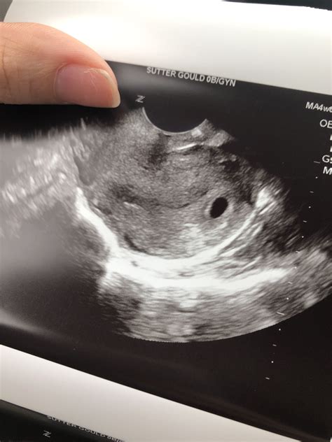 4 Week Ultrasound Pictures