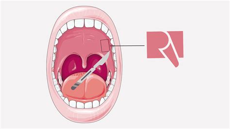 Roof of the mouth after a gum graft: What to expect?