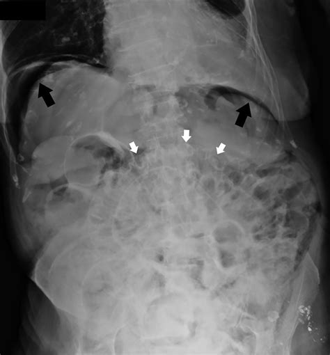 Pneumatosis Cystoides Intestinalis | Applied Radiology