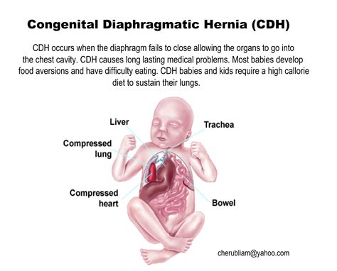 Congenital Diaphragmatic Hernia Awareness