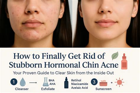 How to Finally Get Rid of Stubborn Hormonal Chin Acne - healthysimo.com