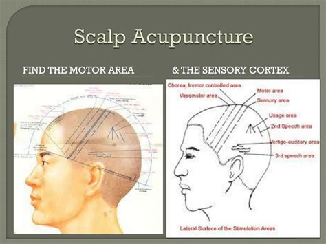https://image3.slideserve.com/6349022/scalp-acupuncture2-l.jpg