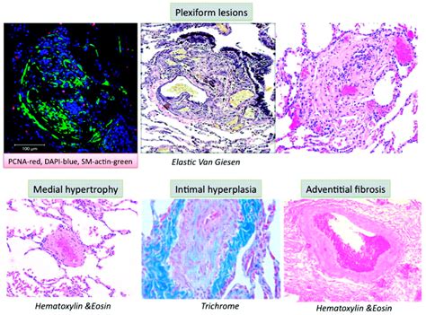 Molecular Pathways in Pulmonary Arterial Hypertension