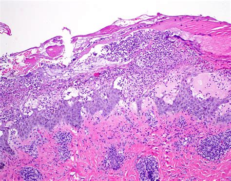 Pathology Outlines - Impetigo contagiosa