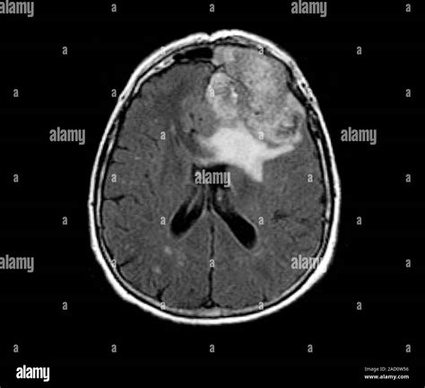 Mri Scan Brain Tumor