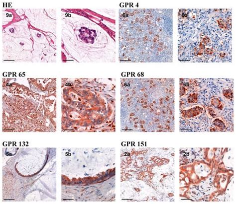 Expression of pH-Sensitive GPCRs in Peritoneal Carcinomatosis of ...