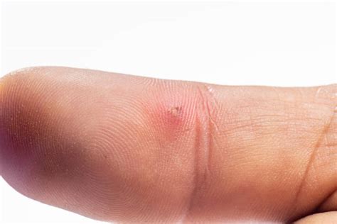 Image result for Splinter in Hand