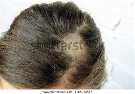 Scalp Parasites 的图像结果