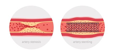 Angiogram & Angioplasty | One is a Test & Other is a Procedure