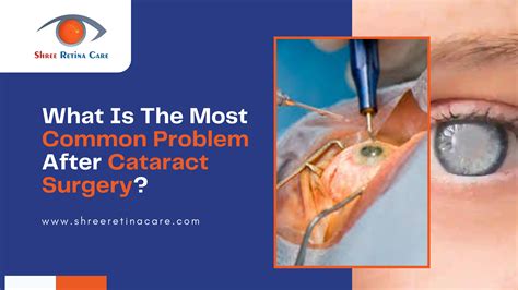 What Causes High Pressure In Your Eye After Cataract Surgery - Infoupdate.org