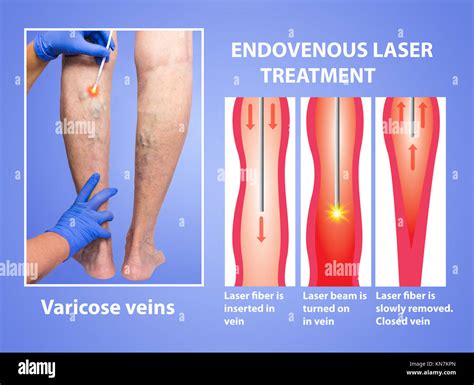 Varicose Veins And Laser