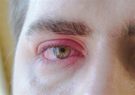 Bildergebnis für augenlidentzündung bilder