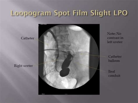 Image result for Distal Loopogram