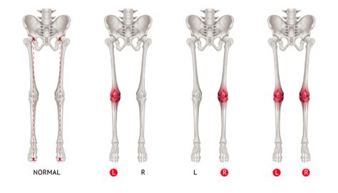 Image result for Leg Alignment