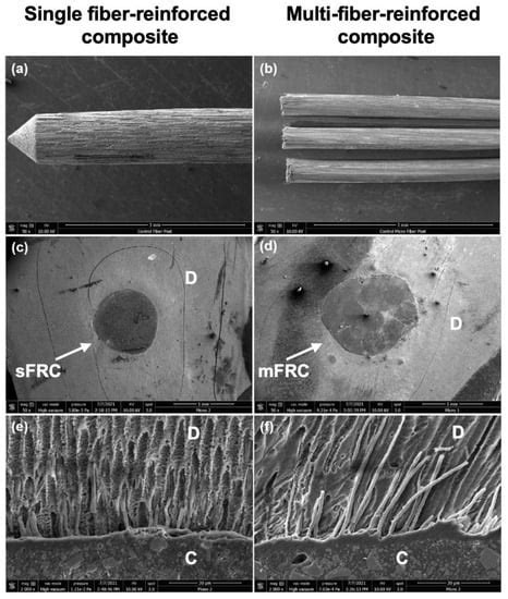 Does Multi-Fiber-Reinforced Composite-Post Influence the Filling ...