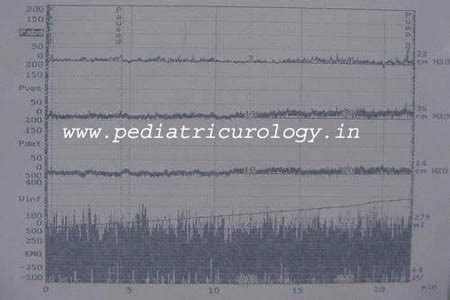 Dysfunctional voiding in children treatment