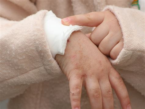 Caxumba em criança: sintomas, cuidados e prevenção | BabyCenter