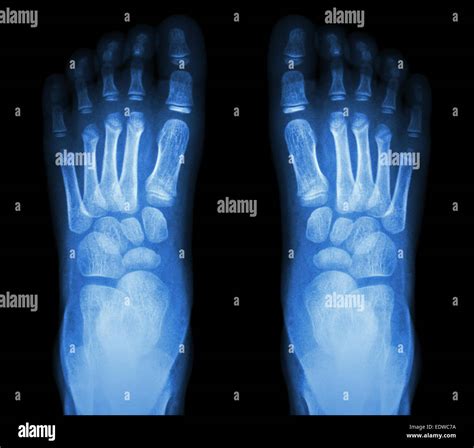 Normal Child Wrist X Ray