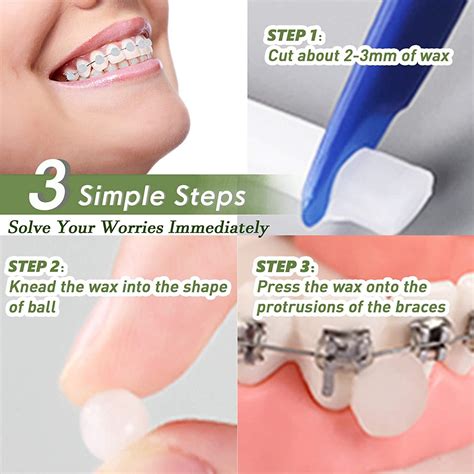 Orthodontic Dental Wax For Braces at Natasha Pruitt blog