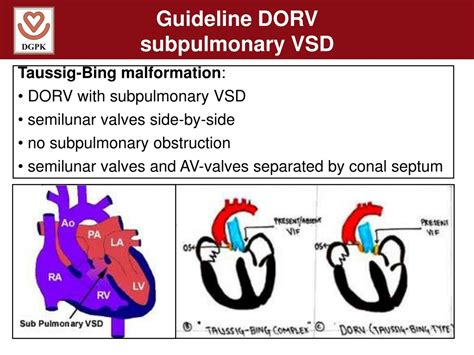 PPT - Guidelines for Double Outlet Right Ventricle (DORV) Diagnosis and ...