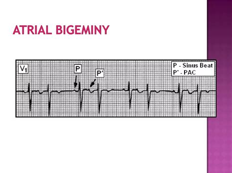 ECG: Multifocal Atrial Tachycardia | PPT