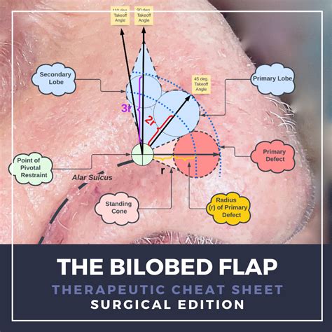 Bilobed Flap Therapeutic Cheat Sheet - Next Steps in Dermatology