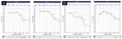 Management of Cerebrospinal Fluid Leakage after Microvascular ...