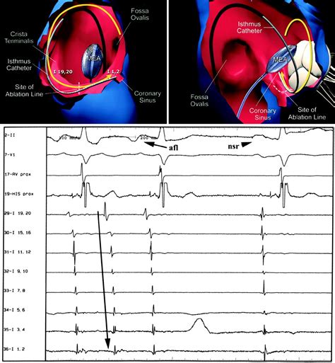 Spot Welding the Gap in Atrial Flutter Ablation | Circulation