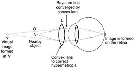 Q.7 Make a diagram to show how hypermetropia is corrected. The near ...