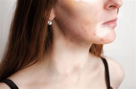 Small White Spots on the Skin and their Natural Treatment – Blue Nectar