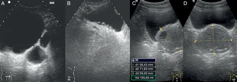 Ecografía del aparato urinario | Medicina de Familia. SEMERGEN