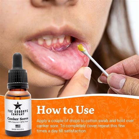 Goodbye Canker Sores - Effective Essential Oil Serum for Mouth Ulcer Relief | Buy Now with ...