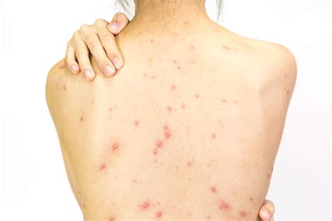 All You Need to Know About Back Acne | Dermatology Times