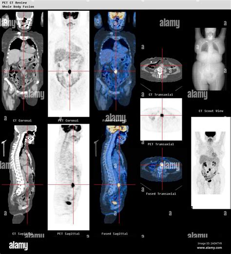 Whole body scans. Coloured computed tomography (CT) and positron emission tomography (PET) scans ...