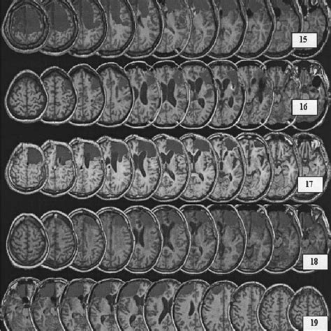 Image result for Prefrontal Cortex Damage