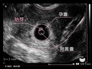 孕囊大小对照表 不同周期孕囊的大小_宫爱网