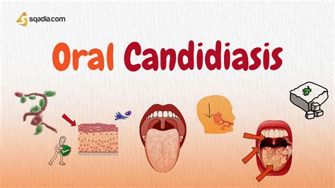 Oral Candidiasis Histology