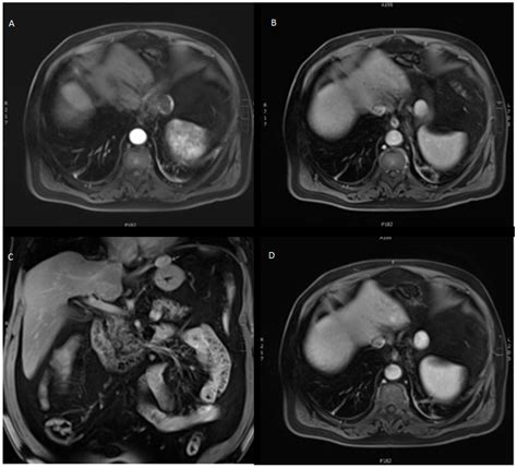 Pedunculated Hepatic Hemangioma Arising from the Left Triangular ...