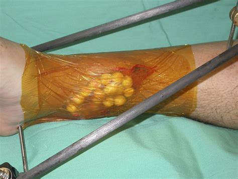 Infections After Fracture - Causes and Treatment - OrthoInfo - AAOS