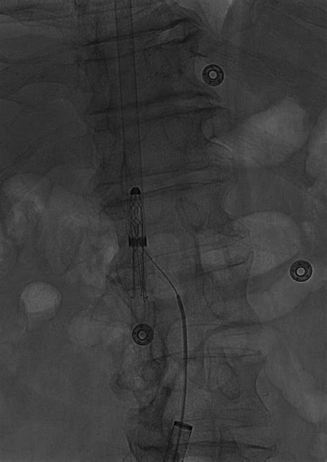 Retrieval of an inferior vena cava Greenfield filter 34 years after insertion | BMJ Case Reports