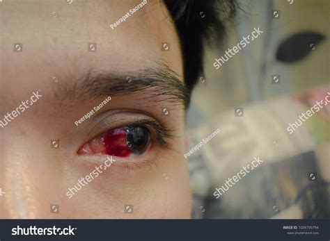 Eye Bleeding Conjunctiva Hemorrhage Human Stock Photo 1009799794 | Shutterstock