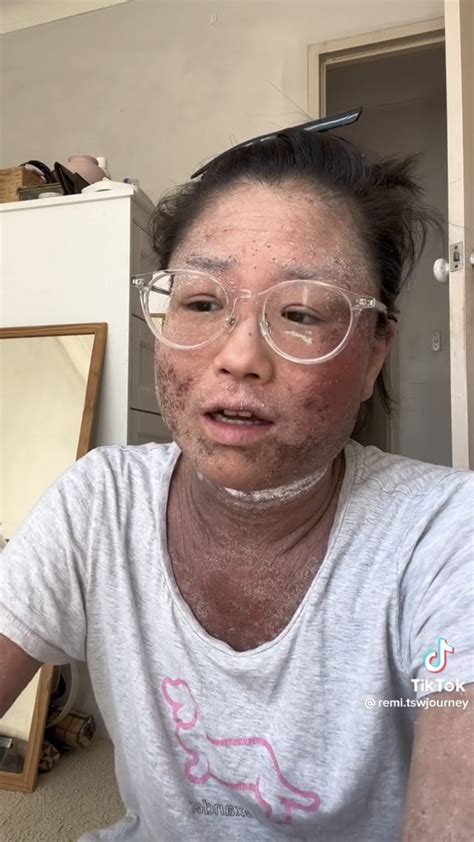 sam is doing commissions on Twitter: "Saw this lady going through topical steroid withdrawal for ...