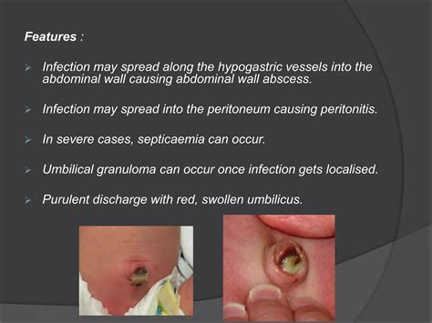 DISEASES OF THE UMBILICUS.pptx