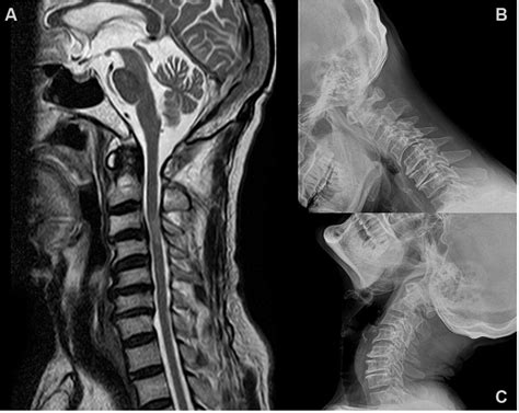 Cervical Spine Mri Comparison Of Phase Sensitive Inversion Recovery