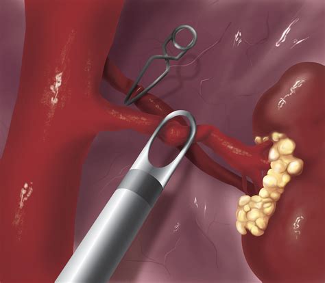Image result for Nephrectomy Procedure