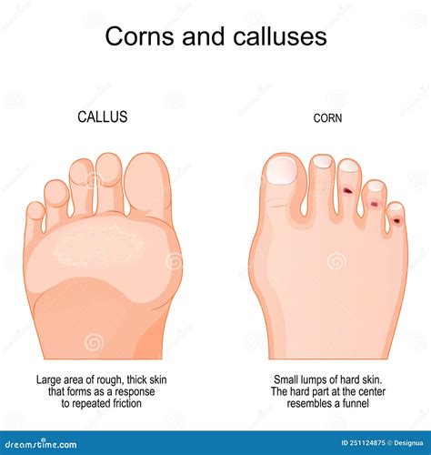 Feet Callus Or Corn. Swollen Skin With Rough, Yellowing Patch Of Lumpy ...