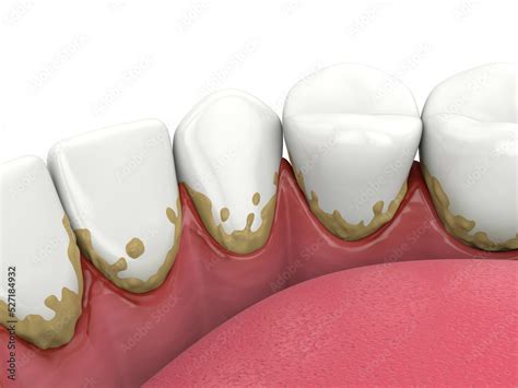 Image result for Calcium Buildup Front Teeth